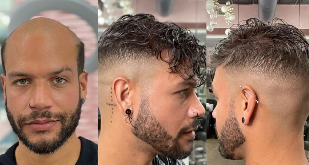 A Beginner’s Guide to Non-Surgical Hair Replacement for Men A Beginner’s Guide to Non-Surgical Hair Replacement for Men
